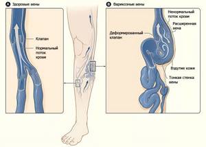 причины варикозное расширение вен на ногах симптомы и лечение