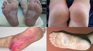псориаз на ногах симптомы и лечение