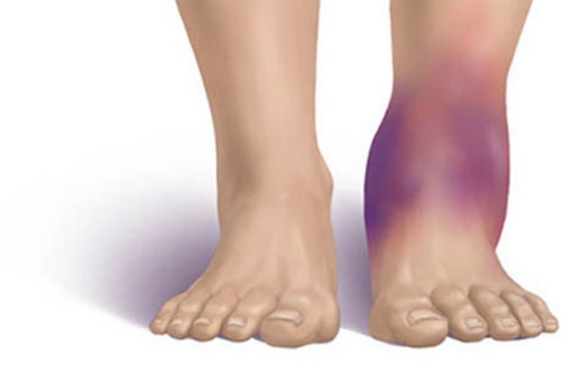 растяжение ноги симптомы и лечение