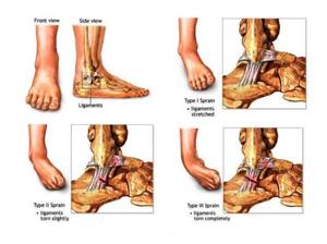 растяжение ноги симптомы лечение