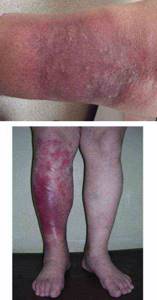 рожистое воспаление ноги симптомы и лечение как передается