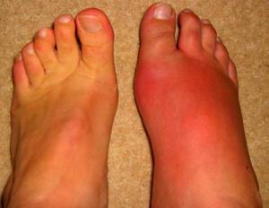 рожистое воспаление ноги симптомы и лечение в домашних