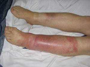 рожистое воспаление ноги симптомы и народное лечение