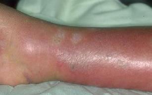 рожистое воспаление ноги симптомы и народное лечение