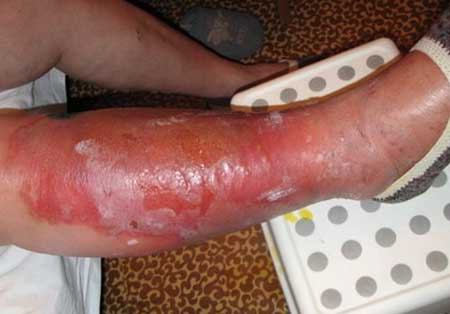 рожистое воспаление ноги симптомы лечение