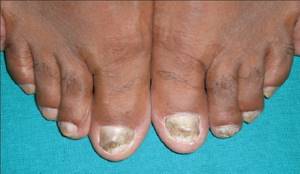 симптомы грибка ногтей на ногах лечение
