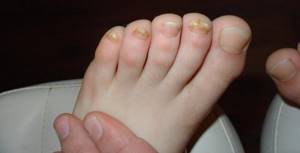 симптомы грибка ногтей на ногах лечение