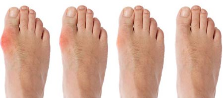 симптомы и лечение подагры на ногах