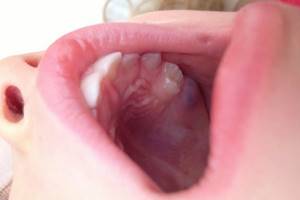 температура у ребенка при прорезывании коренных зубов симптомы и лечение