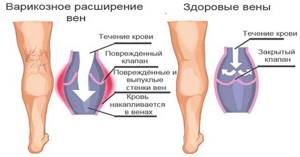 тромбоз ноги симптомы и лечение