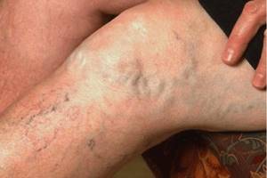 варикоз 1 стадия на ногах симптомы лечение