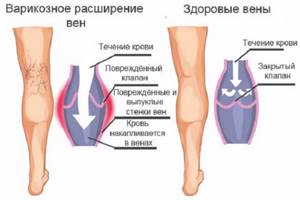 варикоз на ногах симптомы лечение народными средствами
