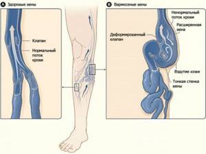варикозное расширение магистральных вен на ногах симптомы и лечение