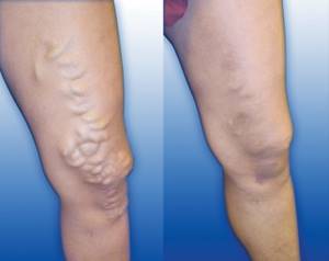 варикозное расширение вен на ногах симптомы и лечение картинки