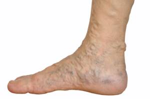 варикозное расширение вен на ногах симптомы и лечение народными