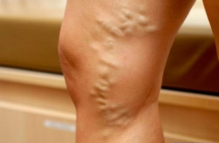 варикозное расширение вен на ногах симптомы и лечение у подростков