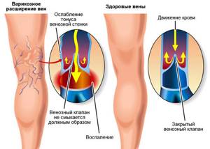 варикозное расширение вен на ногах симптомы и лечение у женщин