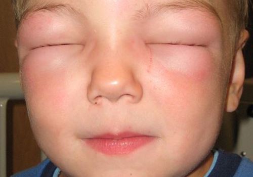 вирусный артрит симптомы у детей лечение