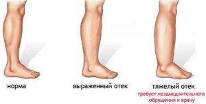 внутренние вены на ногах симптомы и лечение
