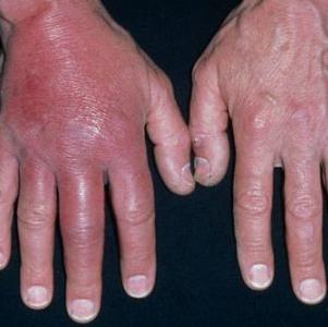 воспаление кожи ноги симптомы и лечение в домашних условиях