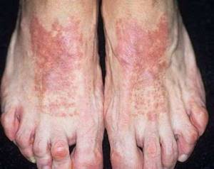 воспаление кожи стопы ноги симптомы и лечение
