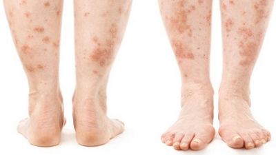 воспаление кожи стопы ноги симптомы и лечение