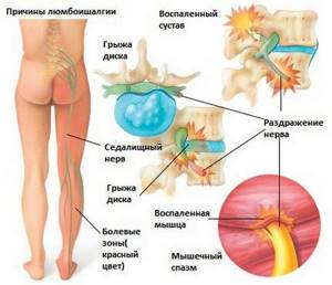 воспаление нерва ноги симптомы и лечение