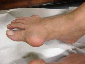 воспаление сустава ноги симптомы и лечение