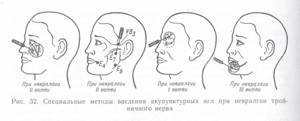 воспаление тройничного нерва на лице у ребенка симптомы и лечение