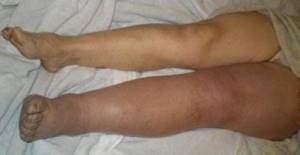 воспаление вен на ногах симптомы и лечение