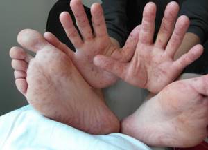 заболевание рука нога рот симптомы и лечение