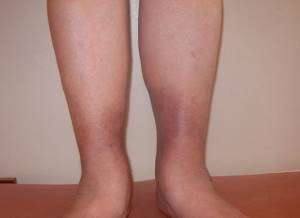 заболевание вен на ногах симптомы лечение