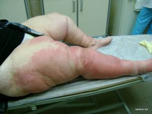 заразно ли рожистое воспаление ноги симптомы и лечение