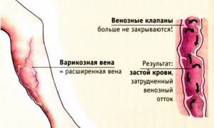 застой крови в ногах симптомы лечение