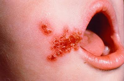золотистый стафилококк у ребенка до года симптомы и лечение