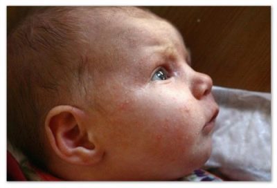 золотистый стафилококк у ребенка симптомы и лечение