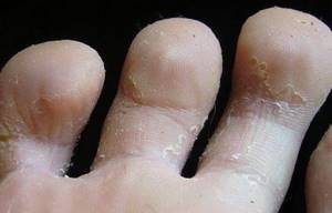 зуд на ногах между пальцев симптомы лечение