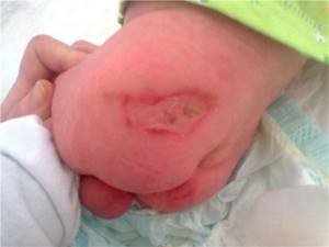 инфекция у новорожденного ребенка симптомы и лечение