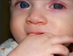 конъюнктивит глаз лечение у детей симптомы