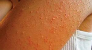 пищевая аллергия у ребенка 2 лет симптомы и лечение