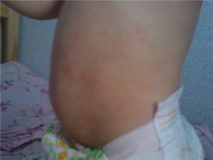 пищевая аллергия у ребенка 2 лет симптомы и лечение