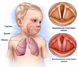 трахеоларингит симптомы и лечение у детей