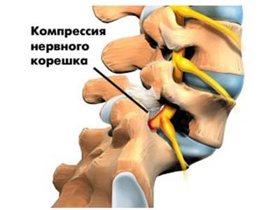 корешковый остеохондроз шейный симптомы лечение