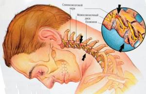 корешковый остеохондроз шейный симптомы лечение