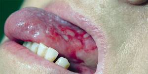 красный плоский лишай полости рта симптомы и лечение