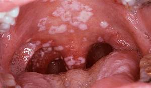 лечение молочница во рту у взрослых симптомы лечение