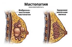 мастопатия молочной железы что это симптомы и лечение