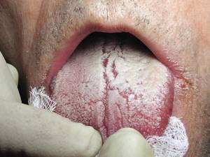 молочница на губах у взрослых симптомы лечение