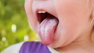 молочница на языке симптомы у взрослых лечение