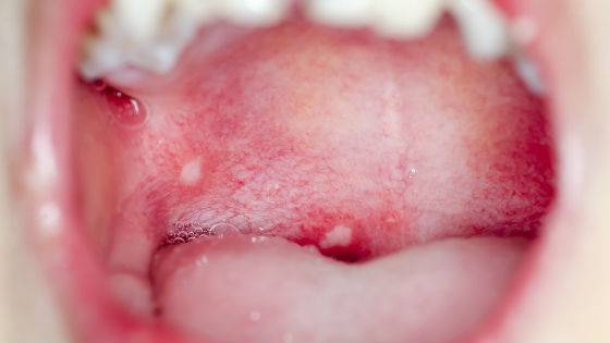 молочница у младенцев во рту лечение симптомы